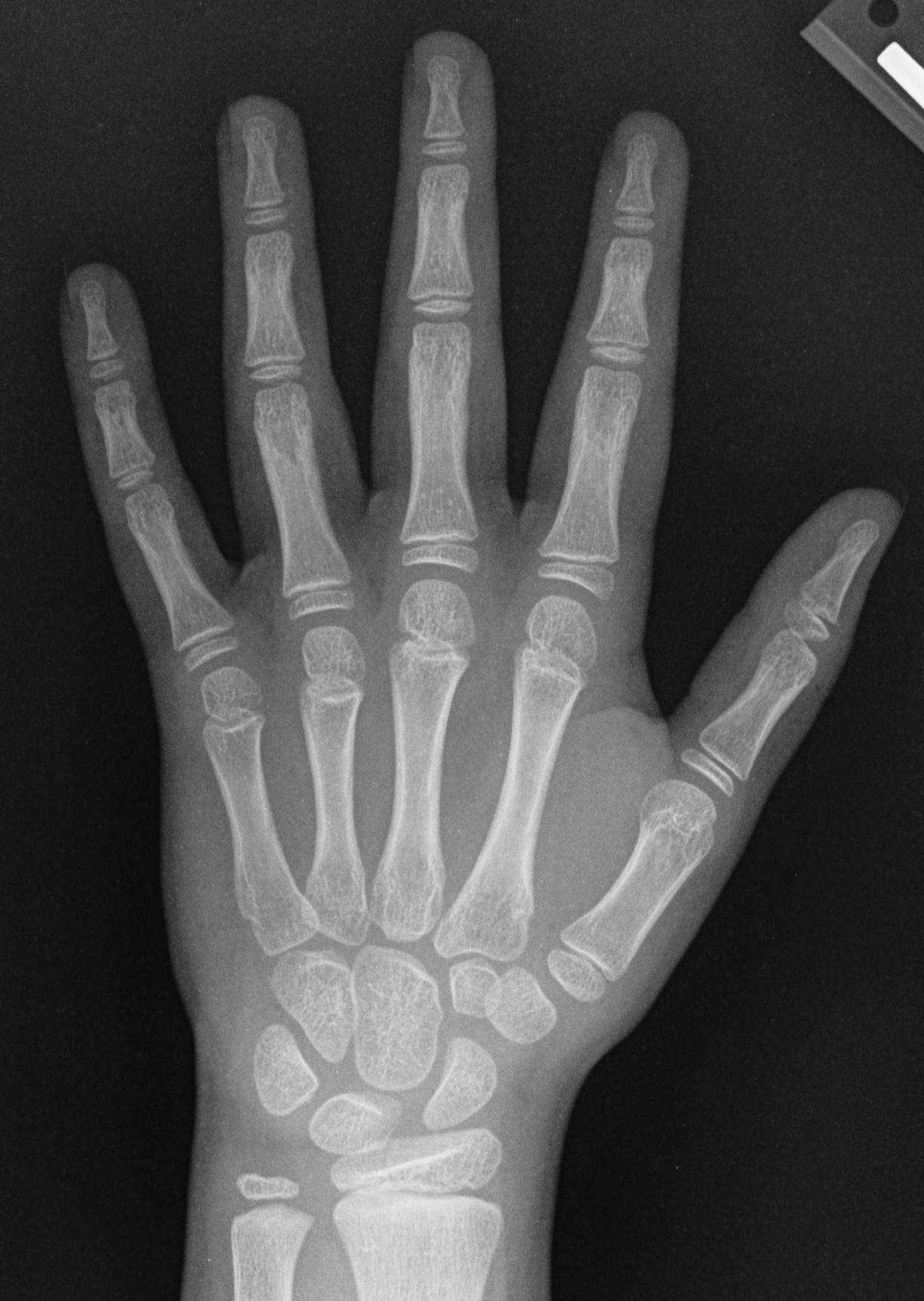 Example pediatric left-hand radiograph