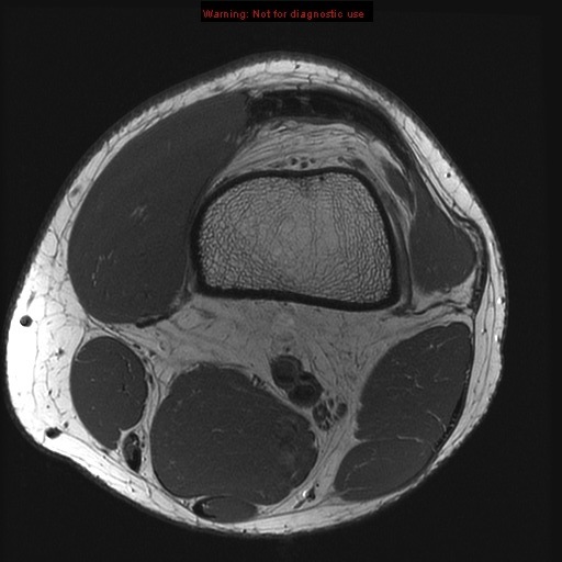 Knee Muscle Anatomy Mri Atlas Of Knee Mri Anatomy Wradiology 1280x660