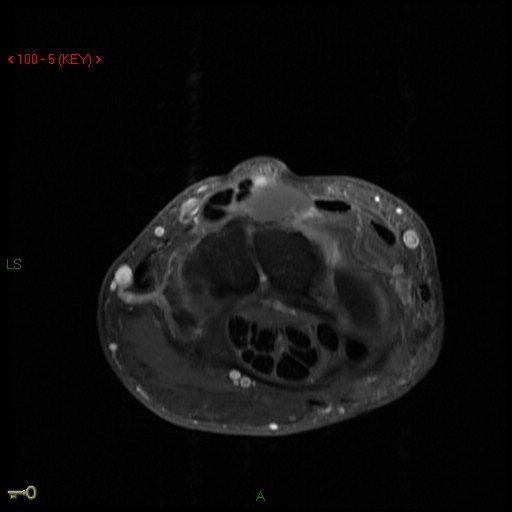 35 Yo W  Lump On Wrist Ro Exostosis. Courtesy Phillip Tirman, Md