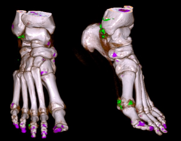 Figure 1 for case Gout