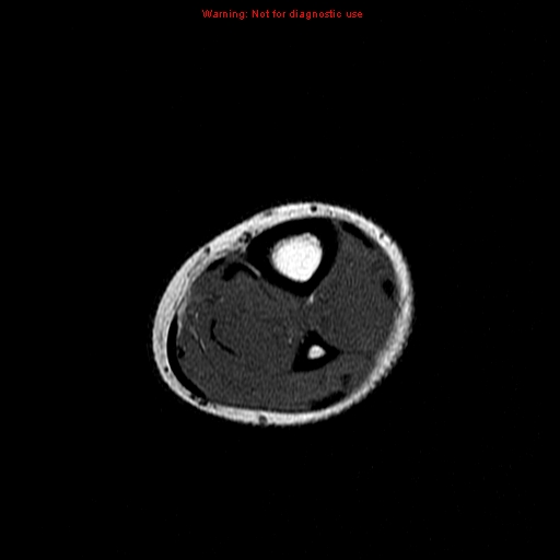 Lower Leg Mri Scan